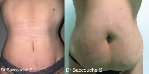 abdominoplastie