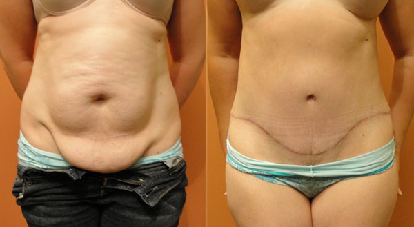 abdominoplastie1