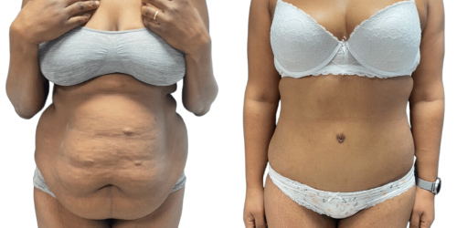 abdominoplastie2