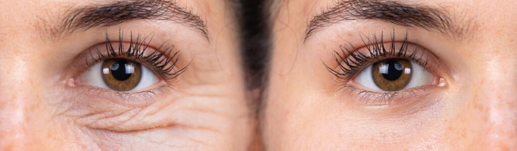 Blepharoplastie 1024x299