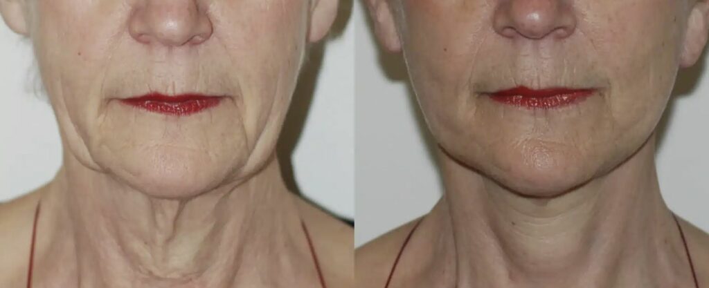 cervico-facial-1