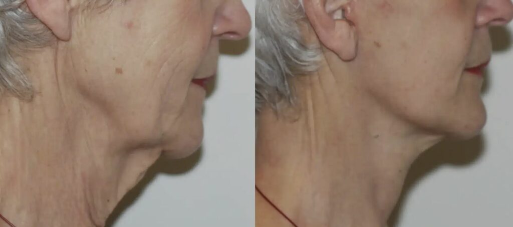 cervico-facial-2
