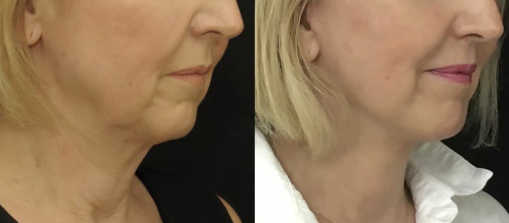cervico-facial-3