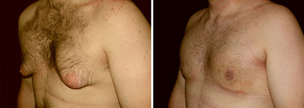 Gynécomastie gynecomastie-1
