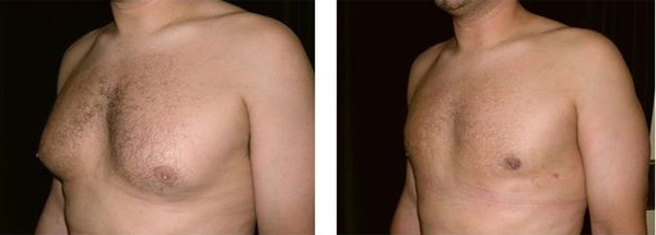 Gynécomastie gynecomastie