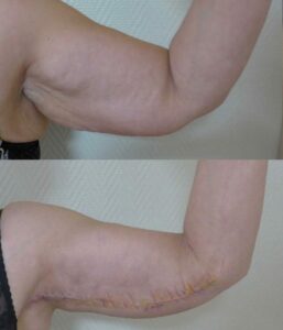 Lifting des bras lifting-bras