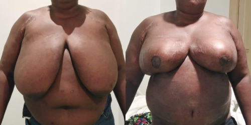 Réduction mammaire lifting-mammaire3