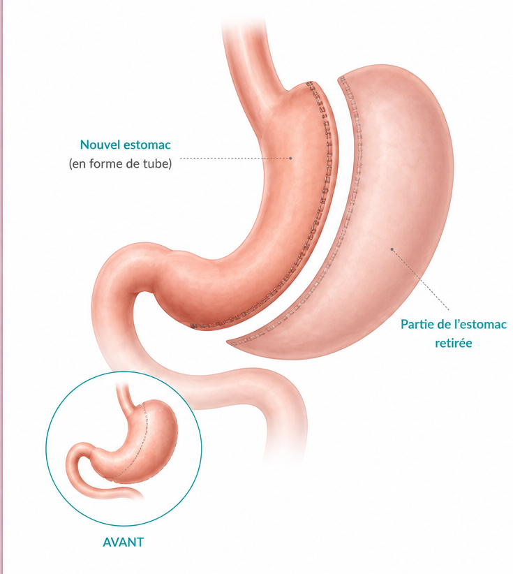 sleeve gastrique clinique